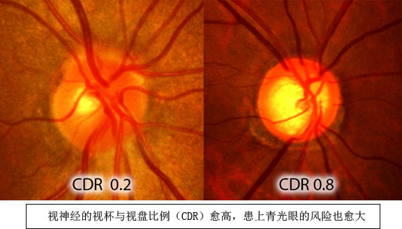 深圳希玛眼科医院青光眼治疗