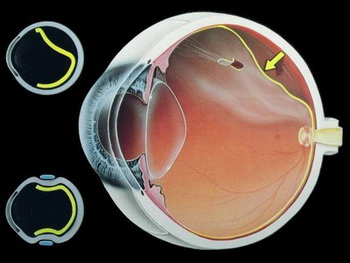 视网膜脱落易造成失明该如何治疗