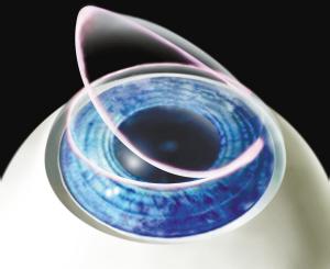 几种个性化激光近视手术方式效果介绍
