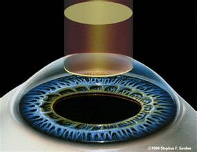 飞秒激光和ICL晶体植入手术安全效果对比
