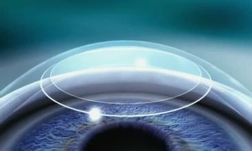 ICL植入与激光近视手术治疗近视最主要区别区别？